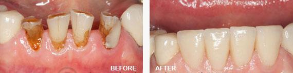 Full Ceramic Emax Crowns Before and After Image