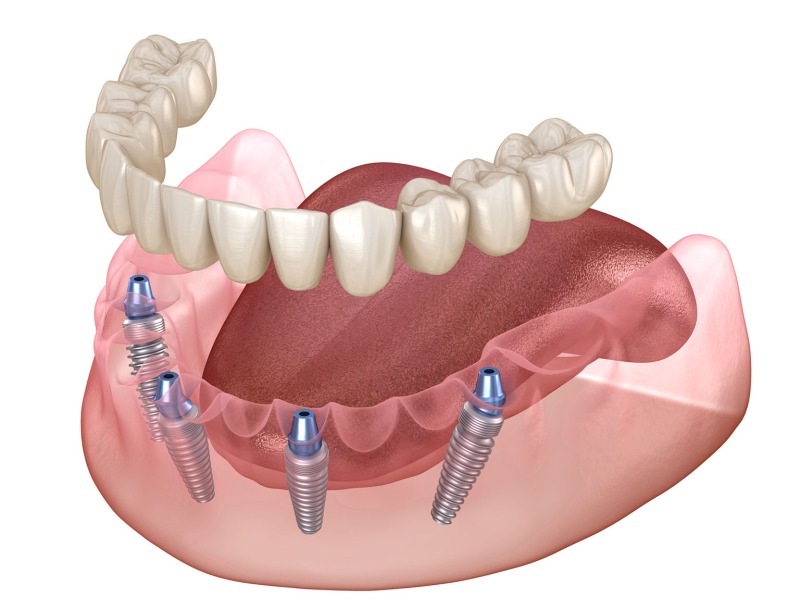 All on 4 Dental Implants in City of London