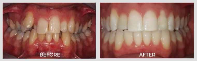 Invisalign Crowding Case Before and After Image