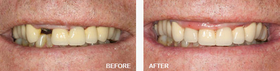 Dental Crowns Before and After Image
