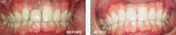 Dental Implants Before and After Image
