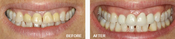 Full Ceramic Crowns Before and After Image