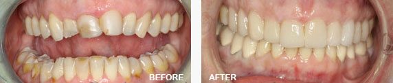 Full Mouth Rehabilitation Before and After Image
