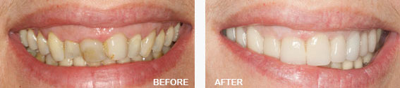 Full Mouth Rehabilitation Before and After Image