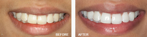 Zoom Teeth Whitening Before and After Image