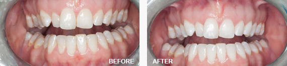 Home Teeth Whitening Before and After Image