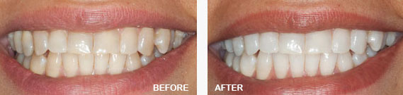 Home Zoom Teeth Whitening Before and After Image