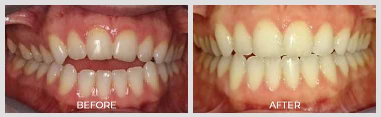 Invisalign Open Bite Case Before and After Image