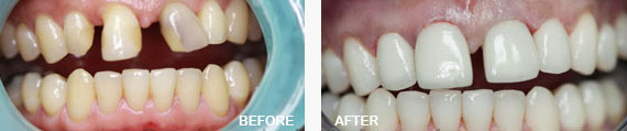 Porcelain Crown before and after image