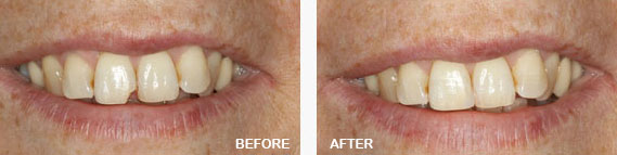 Restorative Dental Filling Before and After Image