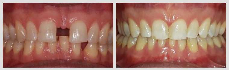 Invisalign Gaps between Teeth Case Before and After