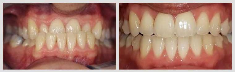 Invisalign Under Bite Case Before and After Image