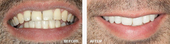 Zoom Office Teeth Whitening Kit Before and After Image